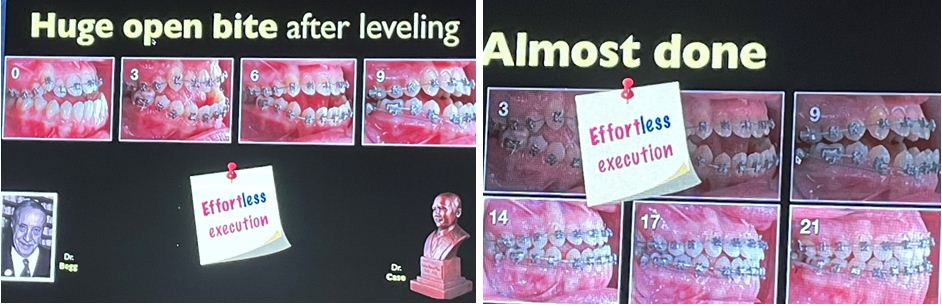 Sự thay đổi rõ rệt của hàm răng và khớp cắn của bệnh nhân